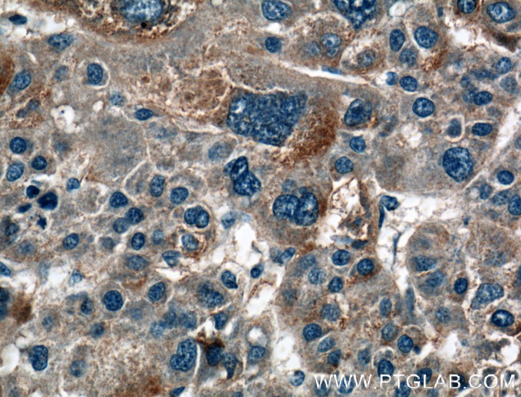 Immunohistochemistry (IHC) staining of human liver cancer tissue using HAS3 Polyclonal antibody (15609-1-AP)