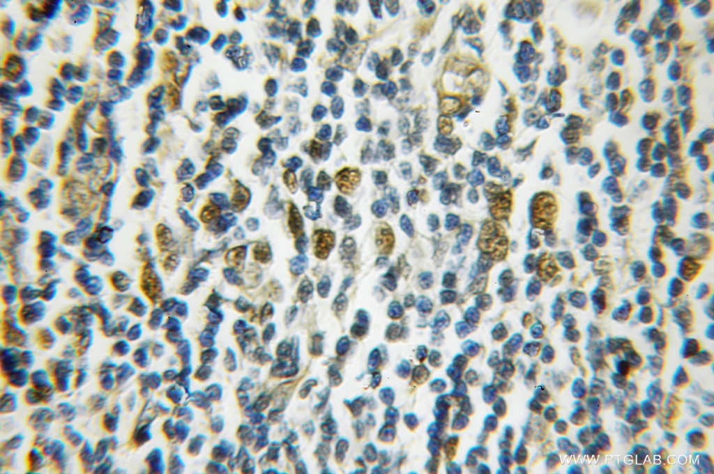IHC staining of human lymphoma using 11432-1-AP