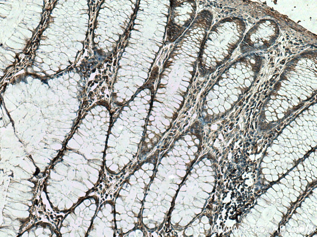 Immunohistochemistry (IHC) staining of human colon cancer tissue using HAUS4 Polyclonal antibody (20104-1-AP)