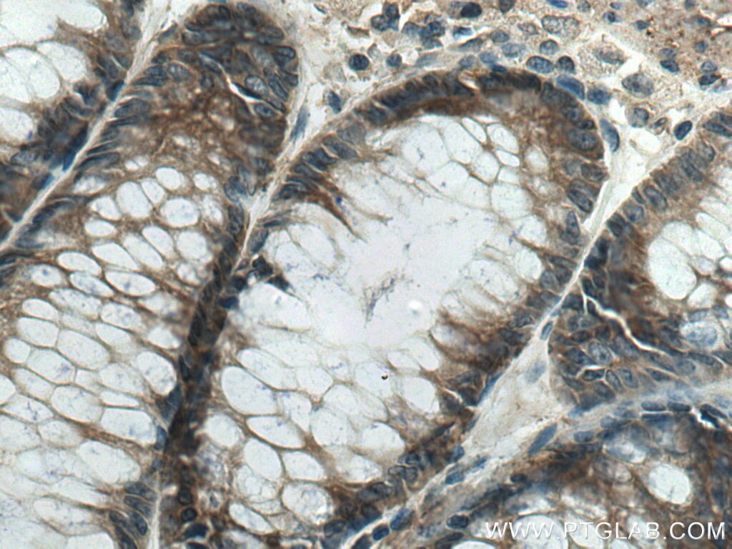 Immunohistochemistry (IHC) staining of human colon cancer tissue using HAUS4 Polyclonal antibody (20104-1-AP)