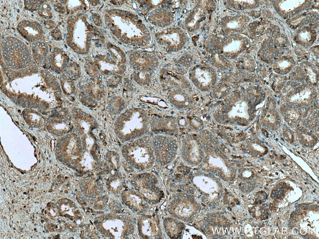 Immunohistochemistry (IHC) staining of human prostate cancer tissue using HAUS4 Polyclonal antibody (20104-1-AP)