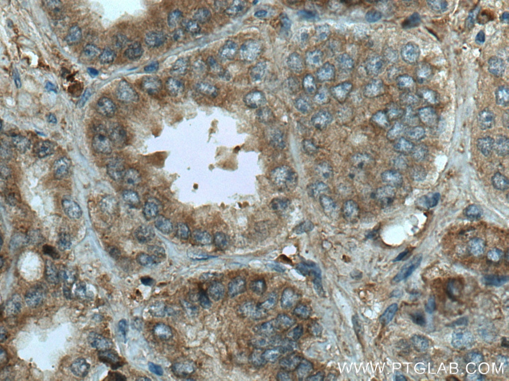 Immunohistochemistry (IHC) staining of human prostate cancer tissue using HAUS4 Polyclonal antibody (20104-1-AP)