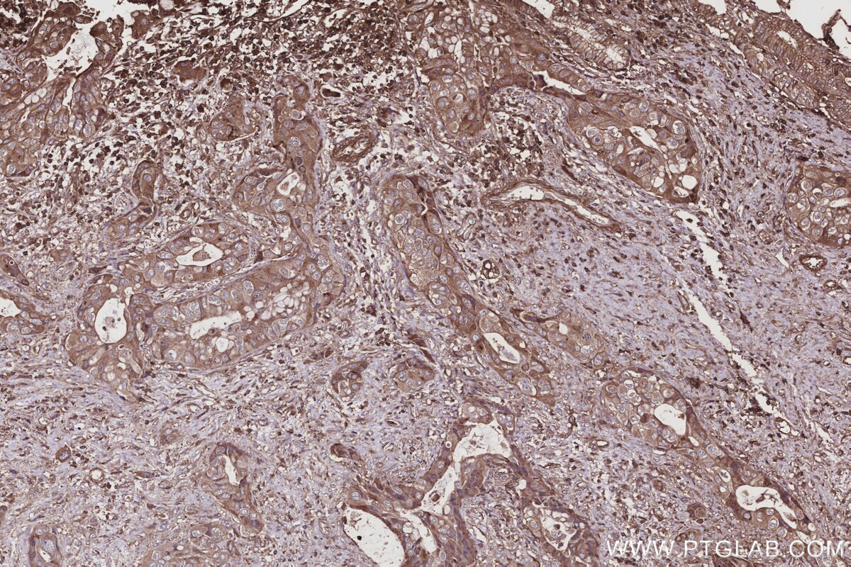 Immunohistochemistry (IHC) staining of human pancreas cancer tissue using HAUS4 Polyclonal antibody (20104-1-AP)