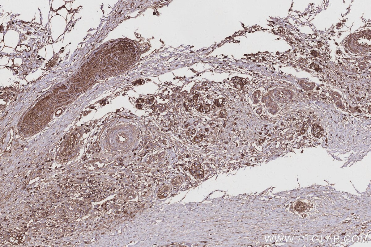 Immunohistochemistry (IHC) staining of human pancreas cancer tissue using HAUS4 Polyclonal antibody (20104-1-AP)
