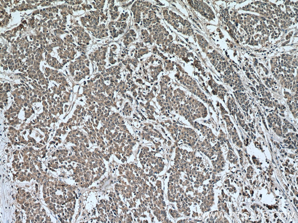 Immunohistochemistry (IHC) staining of human colon cancer tissue using HAVCR1 Polyclonal antibody (26420-1-AP)