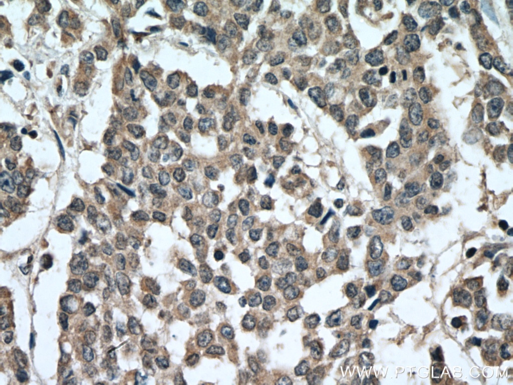 IHC staining of human colon cancer using 26420-1-AP