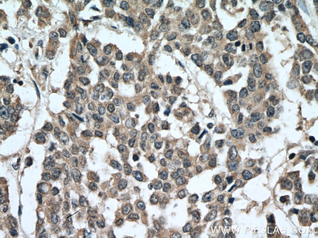 Immunohistochemistry (IHC) staining of human colon cancer tissue using HAVCR1 Polyclonal antibody (26420-1-AP)