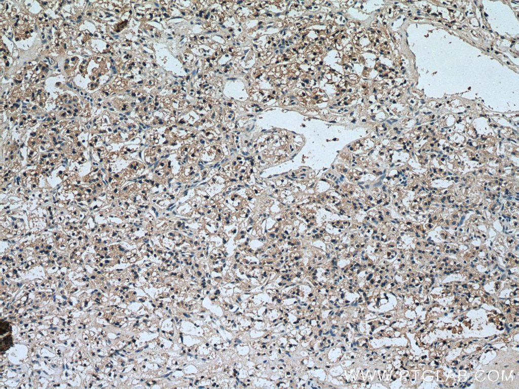 Immunohistochemistry (IHC) staining of human renal cell carcinoma tissue using HAVCR1 Polyclonal antibody (26420-1-AP)