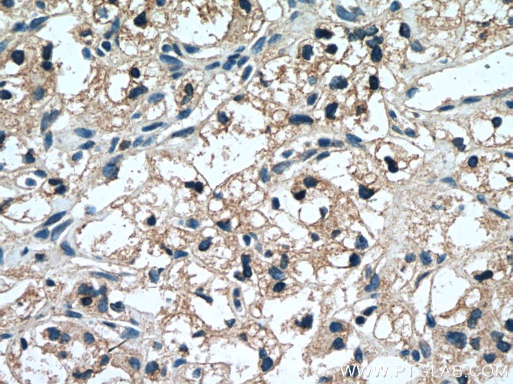 Immunohistochemistry (IHC) staining of human renal cell carcinoma tissue using HAVCR1 Polyclonal antibody (26420-1-AP)