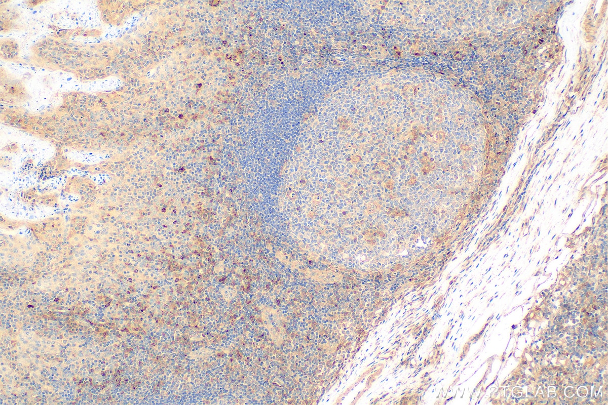 Immunohistochemistry (IHC) staining of human tonsillitis tissue using TIM3 Polyclonal antibody (11872-1-AP)