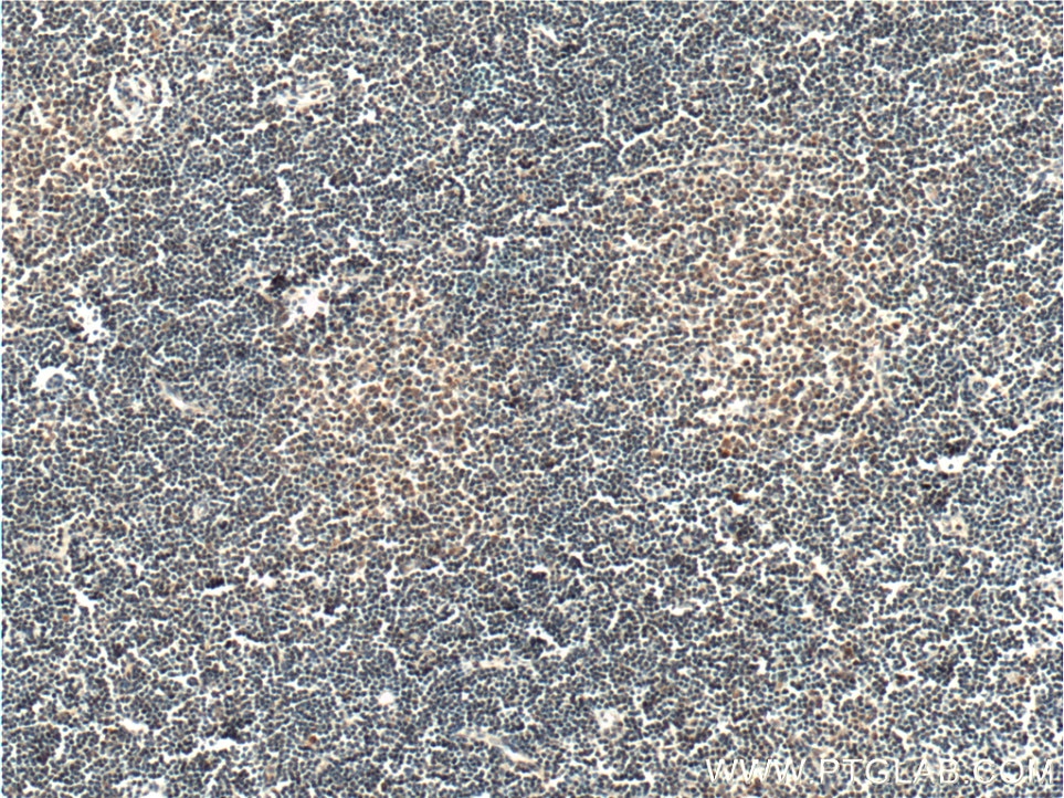 Immunohistochemistry (IHC) staining of human lymphoma tissue using HAX1 Polyclonal antibody (11266-1-AP)