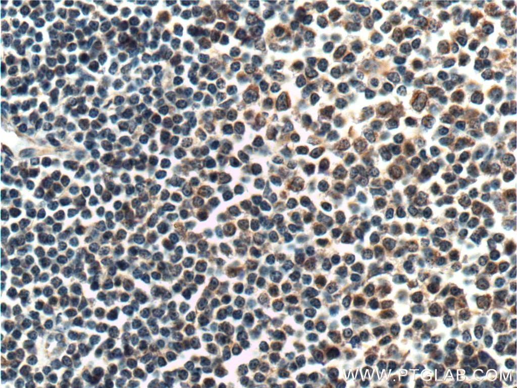 Immunohistochemistry (IHC) staining of human lymphoma tissue using HAX1 Polyclonal antibody (11266-1-AP)