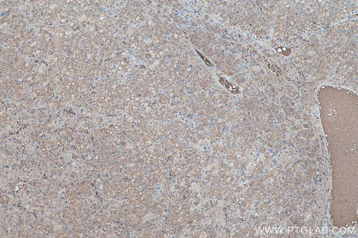 Immunohistochemistry (IHC) staining of human liver cancer tissue using HBB Monoclonal antibody (67899-1-Ig)