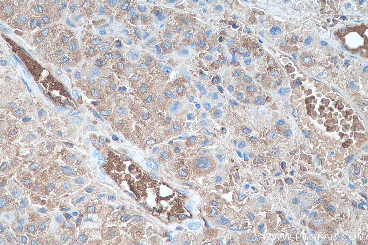Immunohistochemistry (IHC) staining of human liver cancer tissue using HBB Monoclonal antibody (67899-1-Ig)