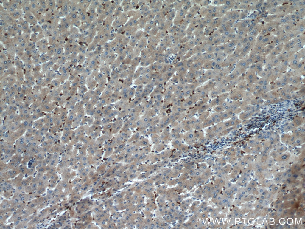 Immunohistochemistry (IHC) staining of human liver cancer tissue using HBQ1 Polyclonal antibody (16706-1-PBS)