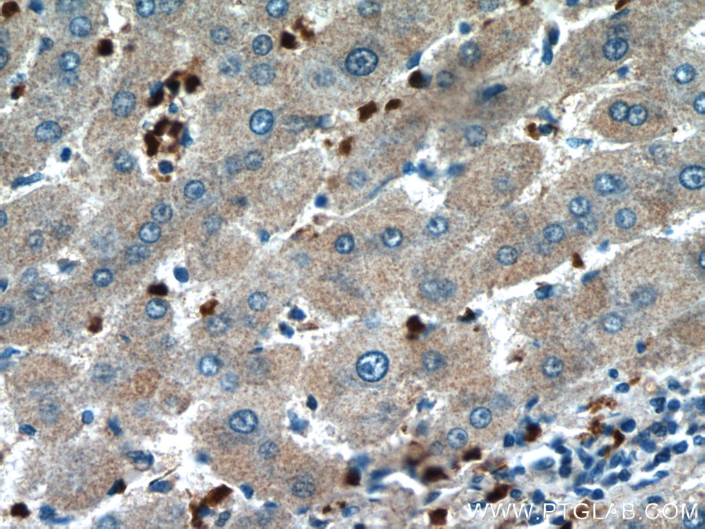 Immunohistochemistry (IHC) staining of human liver cancer tissue using HBQ1 Polyclonal antibody (16706-1-PBS)