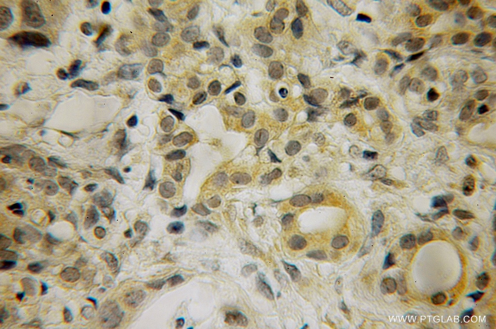 Immunohistochemistry (IHC) staining of human pancreas cancer tissue using HBS1L Polyclonal antibody (10359-1-AP)