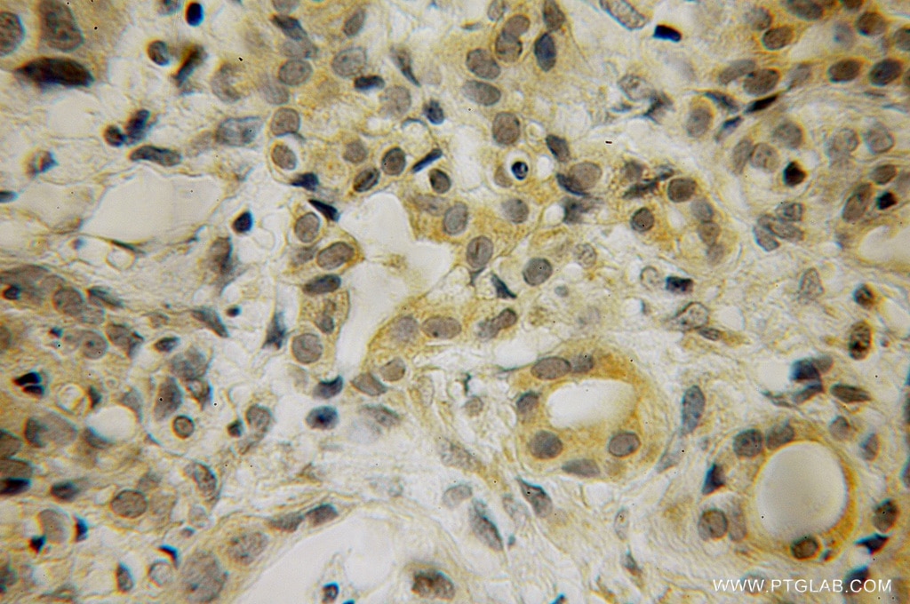 Immunohistochemistry (IHC) staining of human pancreas cancer tissue using HBS1L Polyclonal antibody (10359-1-AP)