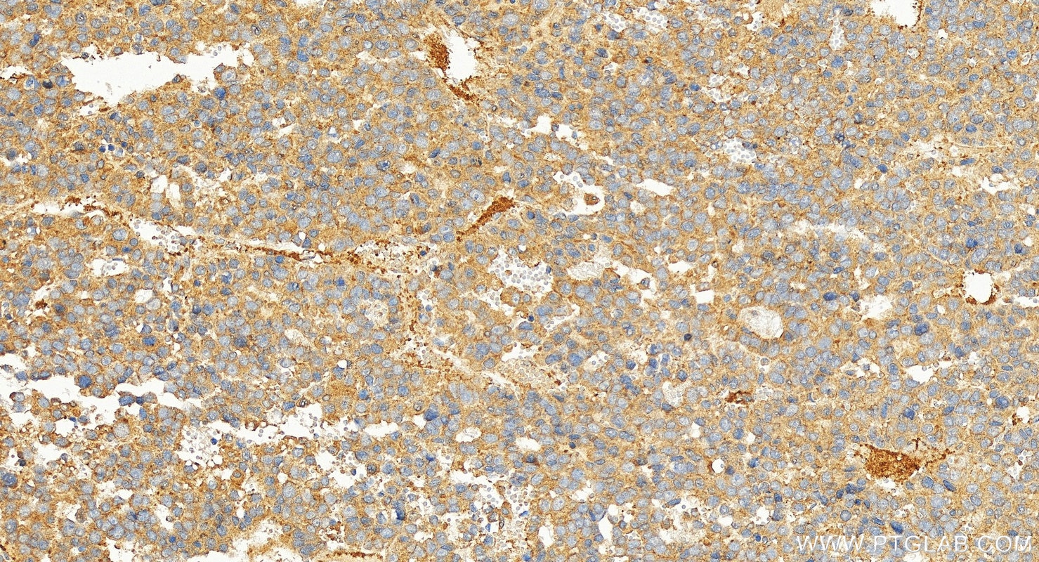 Immunohistochemical analysis of paraffin-embedded human hepatocellular cancer slide using 14492-1-AP (HBXIP antibody) at dilution of 1:400 (under 20x lens). Heat mediated antigen retrieval with Tris-EDTA buffer (pH 9.0). Immunohistochemistry (IHC) staining of human hepatocellular cancer using HBXIP Polyclonal antibody (14492-1-AP)