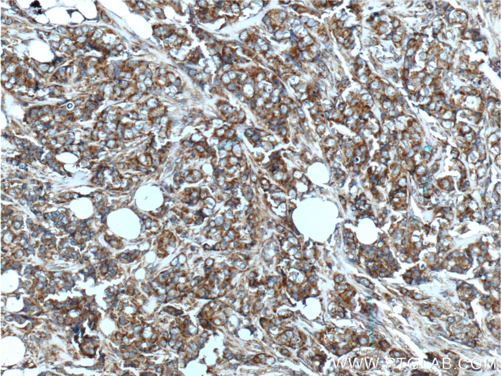 Immunohistochemistry (IHC) staining of human breast cancer tissue using HBXIP Polyclonal antibody (14492-1-AP)
