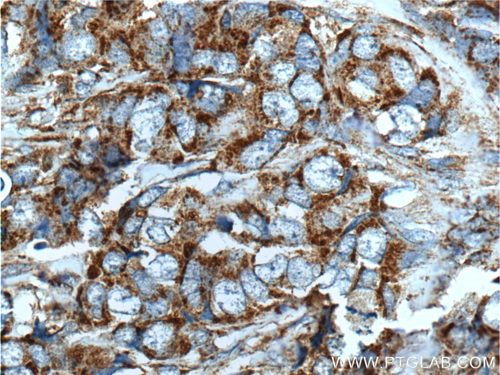 Immunohistochemistry (IHC) staining of human breast cancer tissue using HBXIP Polyclonal antibody (14492-1-AP)