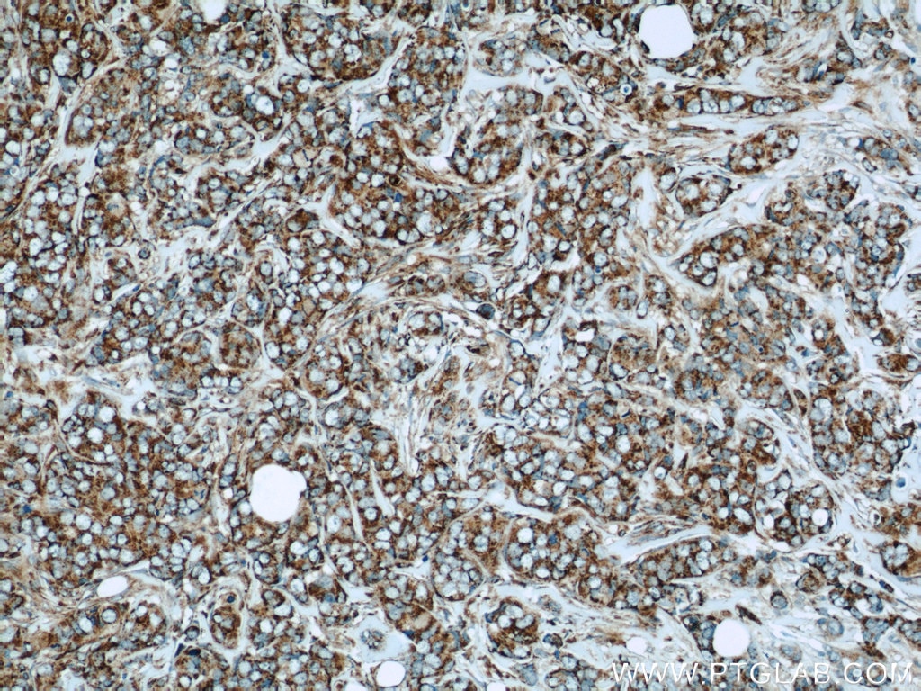 Immunohistochemistry (IHC) staining of human breast cancer tissue using HBXIP Polyclonal antibody (14492-1-AP)