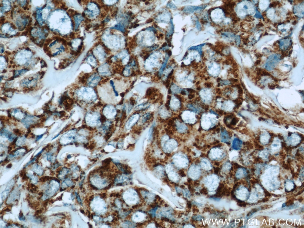 Immunohistochemistry (IHC) staining of human breast cancer tissue using HBXIP Polyclonal antibody (14492-1-AP)