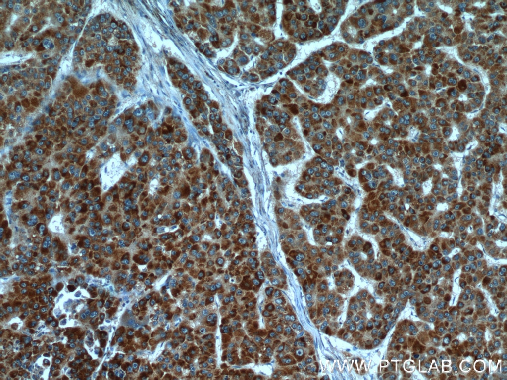 IHC staining of human liver cancer using 14492-1-AP