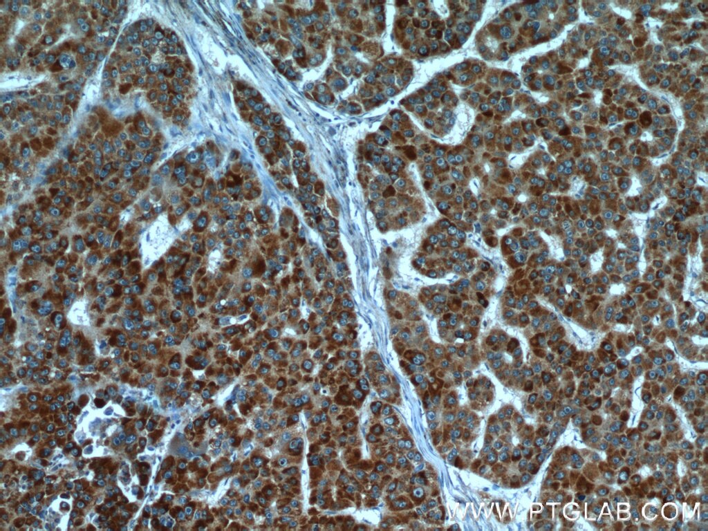 Immunohistochemistry (IHC) staining of human liver cancer tissue using HBXIP Polyclonal antibody (14492-1-AP)