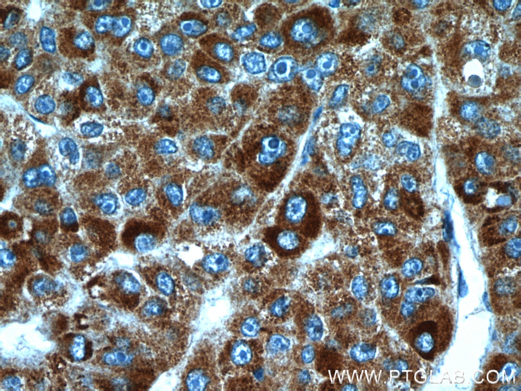 Immunohistochemistry (IHC) staining of human liver cancer tissue using HBXIP Polyclonal antibody (14492-1-AP)