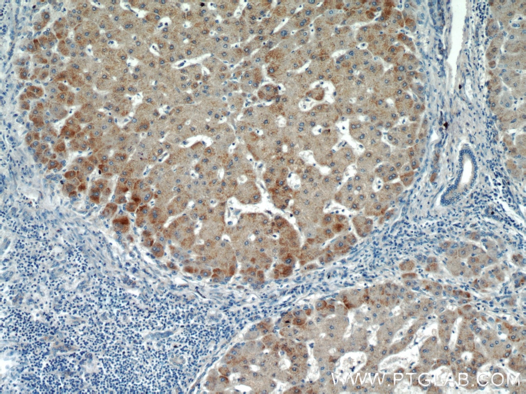 Immunohistochemistry (IHC) staining of human hepatocirrhosis tissue using HBXIP Polyclonal antibody (14492-1-AP)