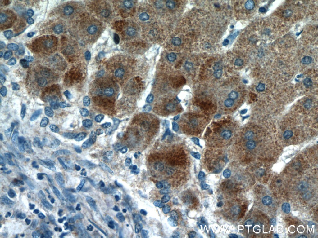 Immunohistochemistry (IHC) staining of human hepatocirrhosis tissue using HBXIP Polyclonal antibody (14492-1-AP)