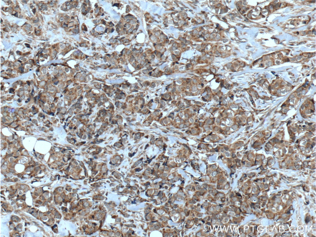 Immunohistochemistry (IHC) staining of human breast cancer tissue using HCCS Polyclonal antibody (15118-1-AP)