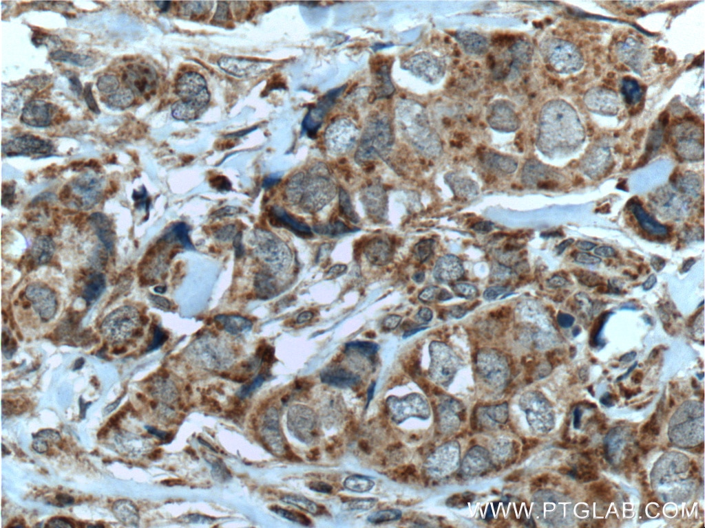 Immunohistochemistry (IHC) staining of human breast cancer tissue using HCCS Polyclonal antibody (15118-1-AP)