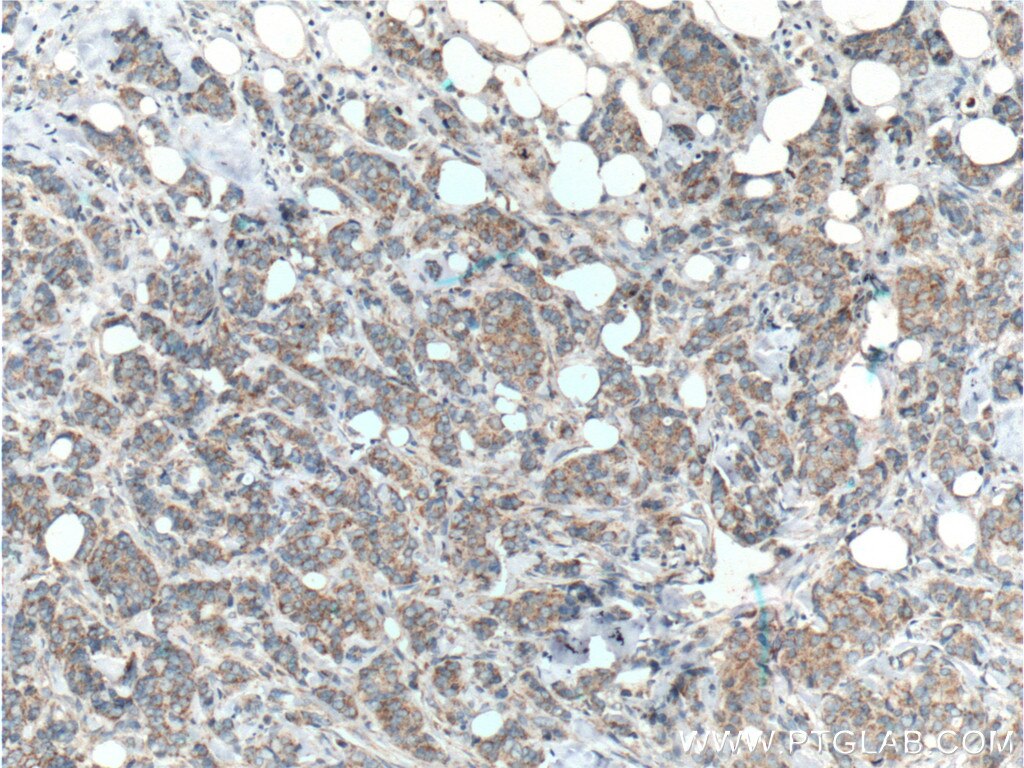 Immunohistochemistry (IHC) staining of human breast cancer tissue using HCCS Polyclonal antibody (15118-1-AP)