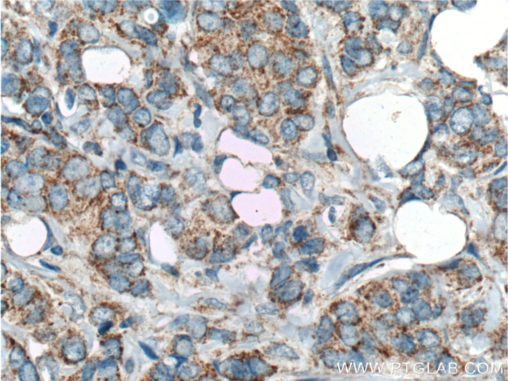 Immunohistochemistry (IHC) staining of human breast cancer tissue using HCCS Polyclonal antibody (15118-1-AP)