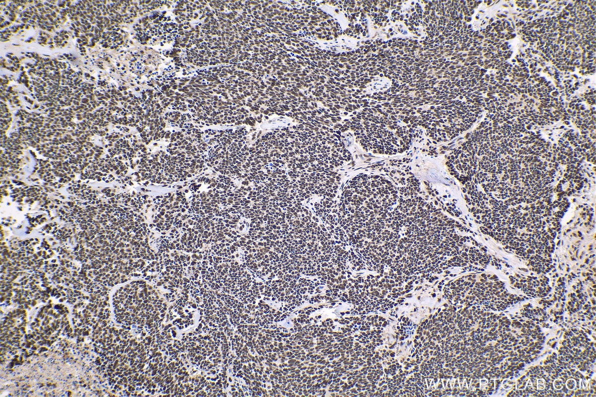 Immunohistochemistry (IHC) staining of human lung cancer tissue using HCFC1 Polyclonal antibody (28569-1-AP)