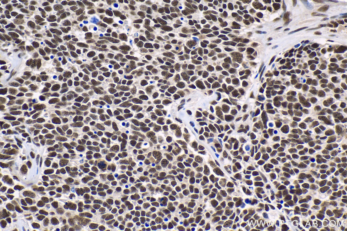 Immunohistochemistry (IHC) staining of human lung cancer tissue using HCFC1 Polyclonal antibody (28569-1-AP)