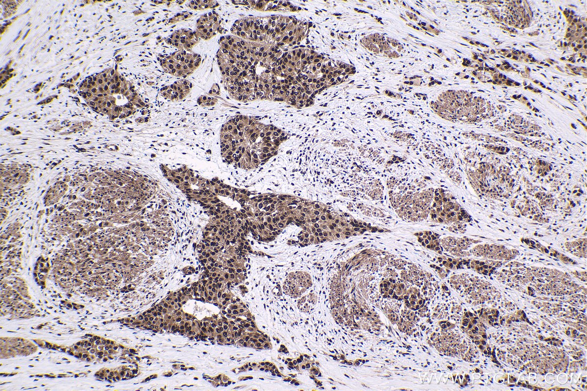 Immunohistochemistry (IHC) staining of human urothelial carcinoma tissue using HCFC1 Polyclonal antibody (28569-1-AP)