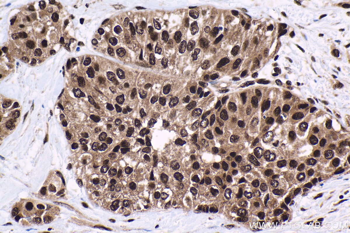 Immunohistochemistry (IHC) staining of human urothelial carcinoma tissue using HCFC1 Polyclonal antibody (28569-1-AP)