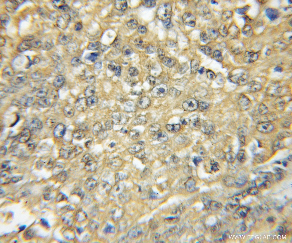 Immunohistochemistry (IHC) staining of human lung cancer tissue using HCK Polyclonal antibody (11600-1-AP)