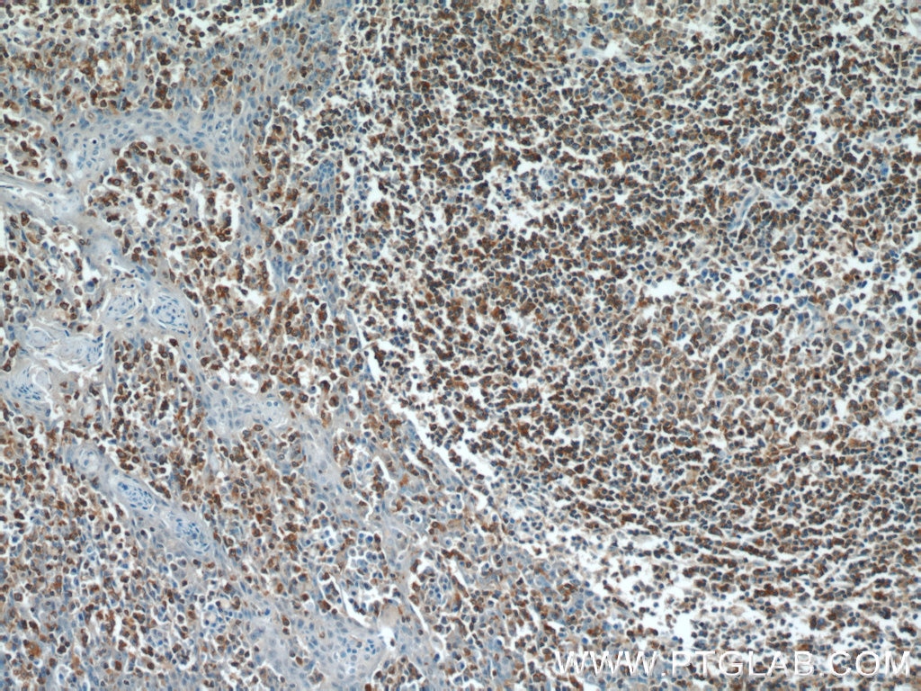 Immunohistochemistry (IHC) staining of human tonsillitis tissue using HCLS1 Polyclonal antibody (25003-1-AP)