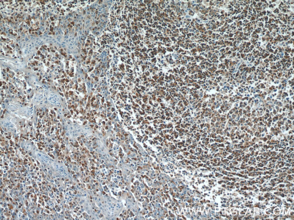 IHC staining of human tonsillitis using 25003-1-AP