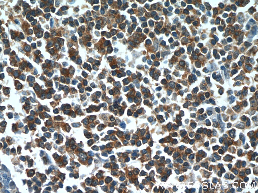 Immunohistochemistry (IHC) staining of human tonsillitis tissue using HCLS1 Polyclonal antibody (25003-1-AP)