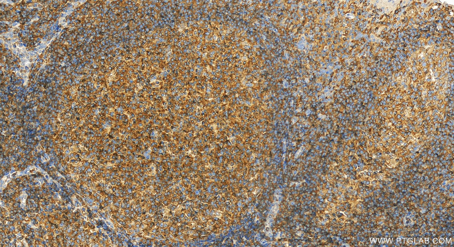 Immunohistochemistry (IHC) staining of human tonsillitis tissue using HCLS1 Polyclonal antibody (25003-1-AP)
