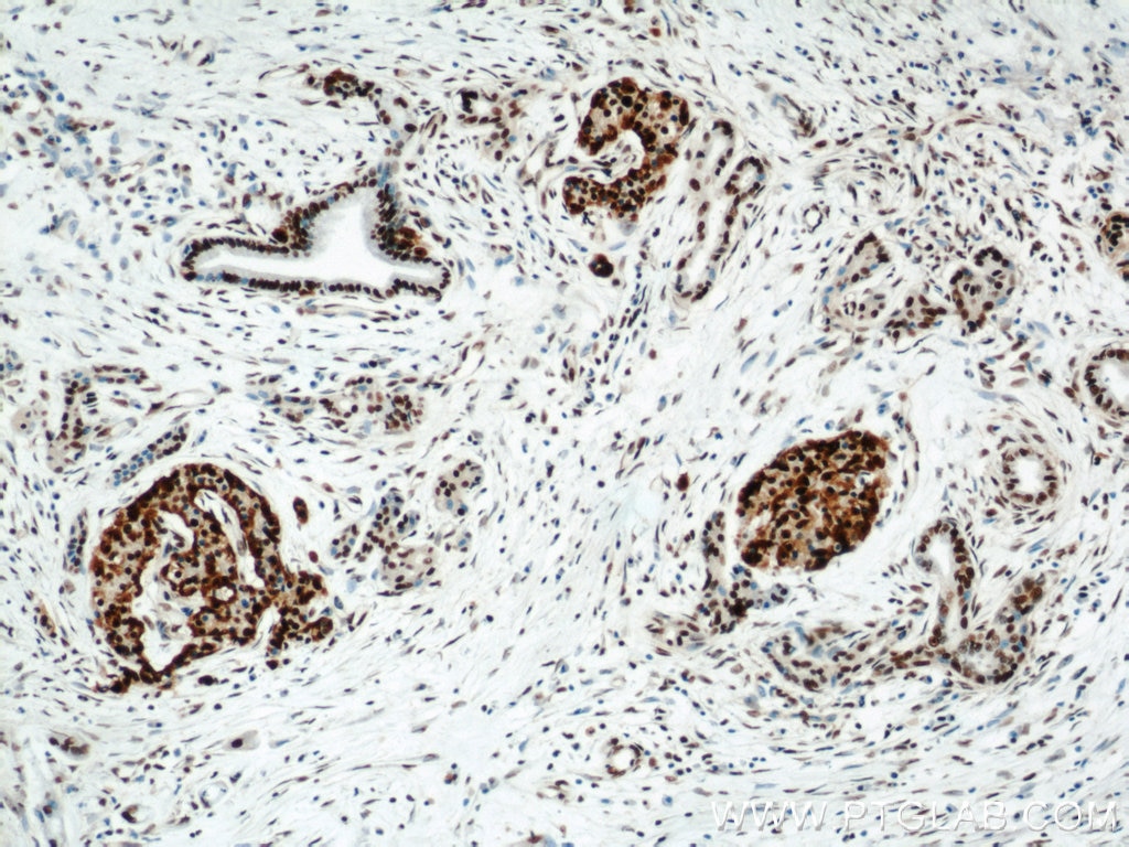 IHC staining of human pancreas cancer using 10197-1-AP