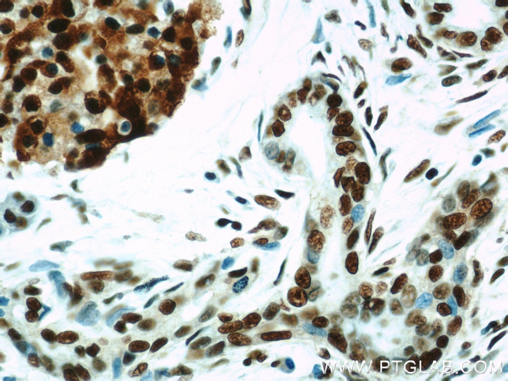 Immunohistochemistry (IHC) staining of human pancreas cancer tissue using HDAC1 Polyclonal antibody (10197-1-AP)