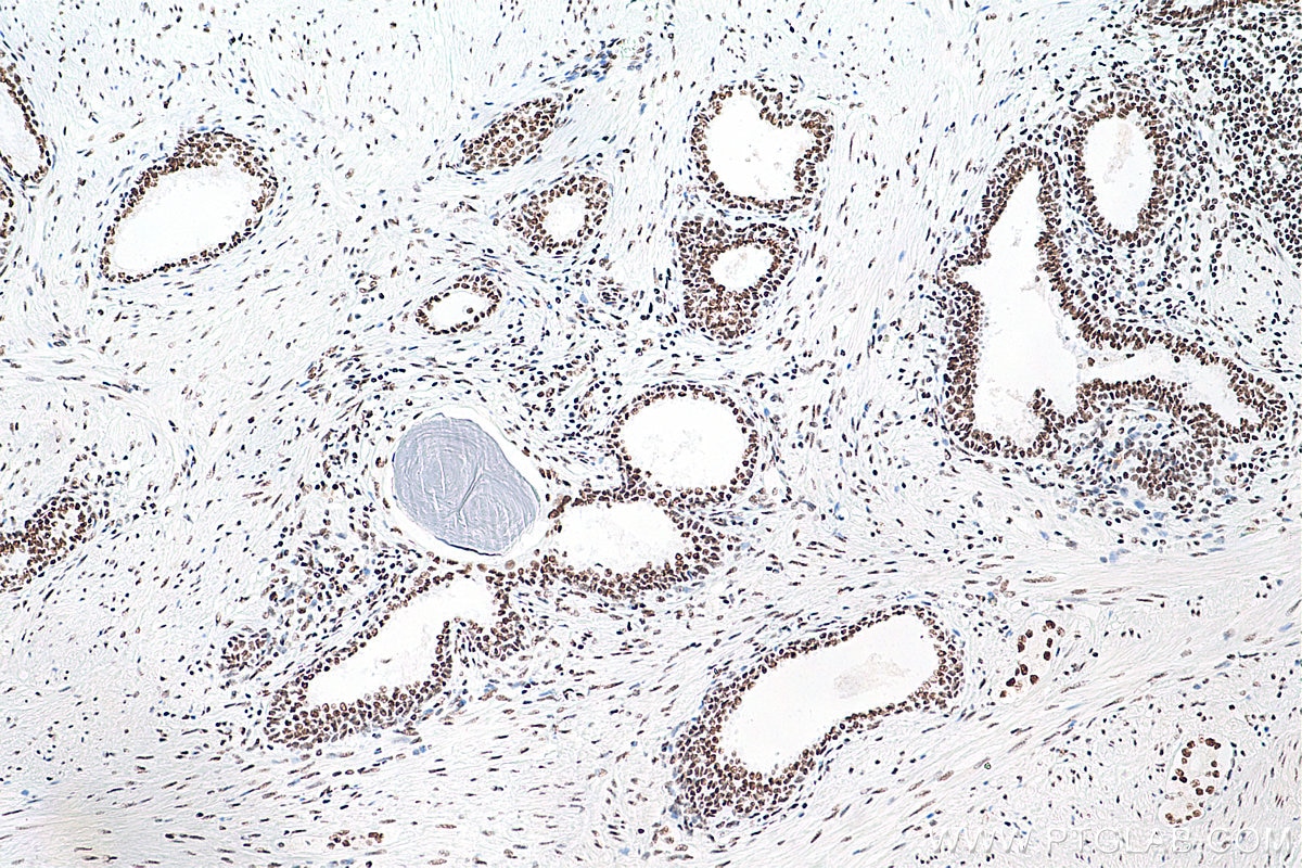 IHC staining of human prostate cancer using 66085-1-Ig