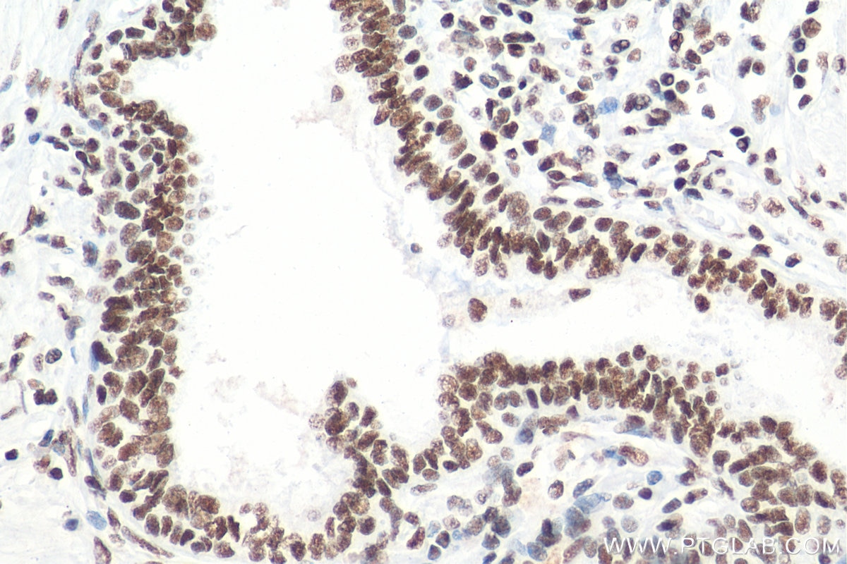 Immunohistochemistry (IHC) staining of human prostate cancer tissue using HDAC1 Monoclonal antibody (66085-1-Ig)