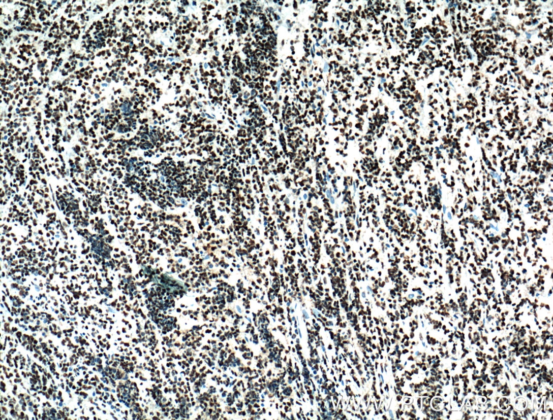 Immunohistochemistry (IHC) staining of human lymphoma tissue using HDAC1 Monoclonal antibody (66085-1-Ig)